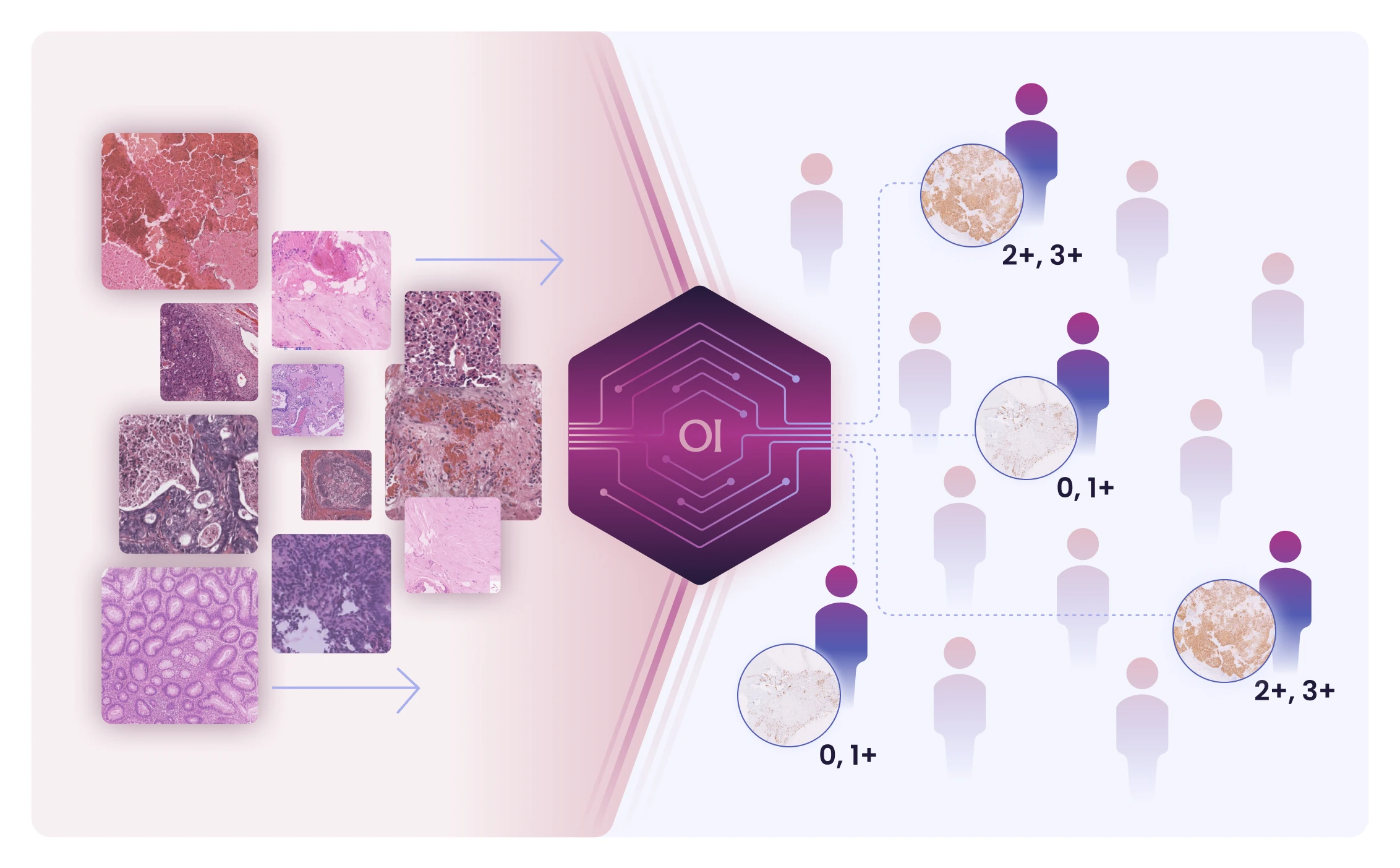 H&E tissue tiles pass through the OI model, which classifies each patient's IHC-stained sample as 0, 1+ or 2+, 3+ protein expression.